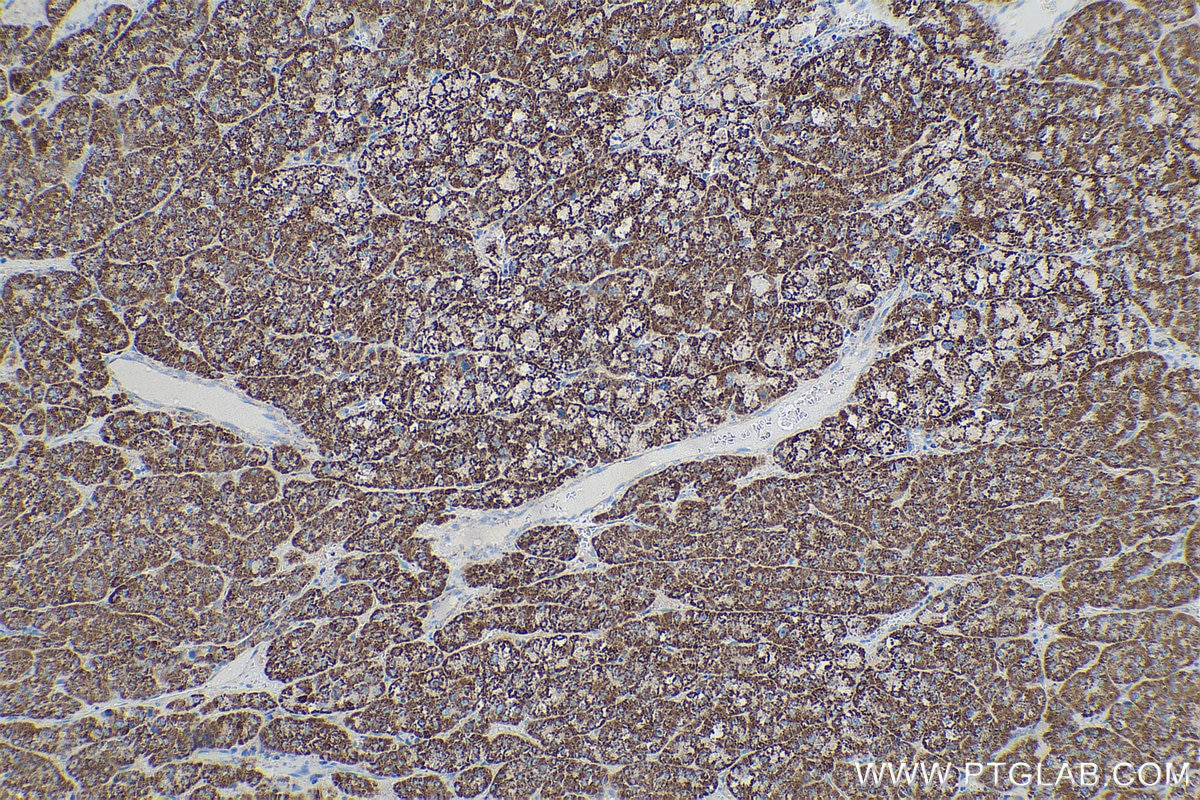 Immunohistochemical analysis of paraffin-embedded human liver cancer tissue slide using KHC0543 (HSD17B10 IHC Kit).