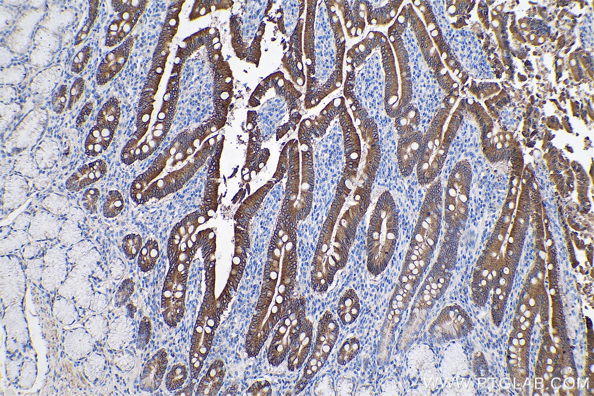 Immunohistochemical analysis of paraffin-embedded human stomach cancer tissue slide using KHC0625 (HSD17B2 IHC Kit).