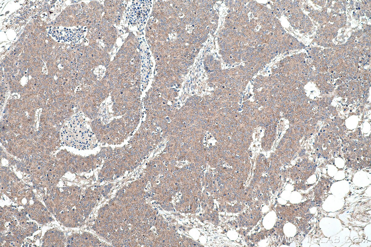 Immunohistochemical analysis of paraffin-embedded human colon cancer tissue slide using KHC0573 (HSD17B4 IHC Kit).