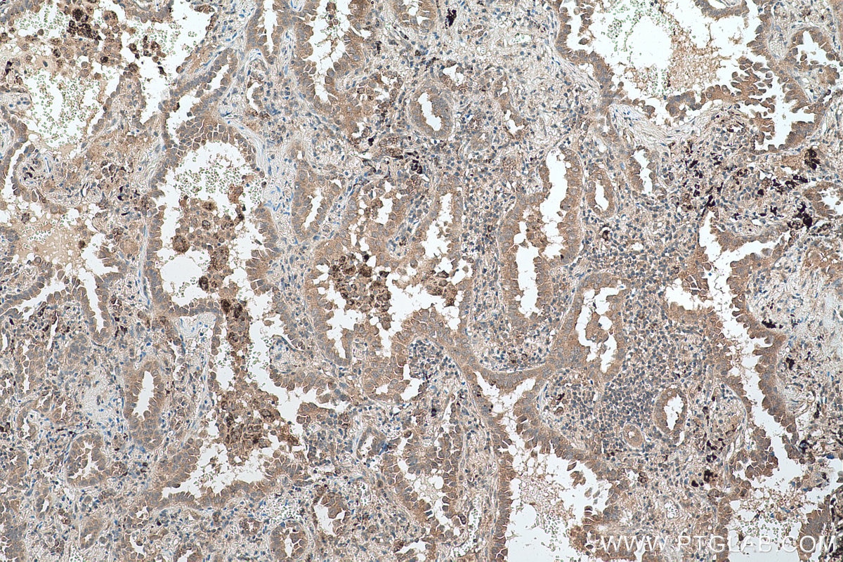 Immunohistochemical analysis of paraffin-embedded human lung cancer tissue slide using KHC0573 (HSD17B4 IHC Kit).