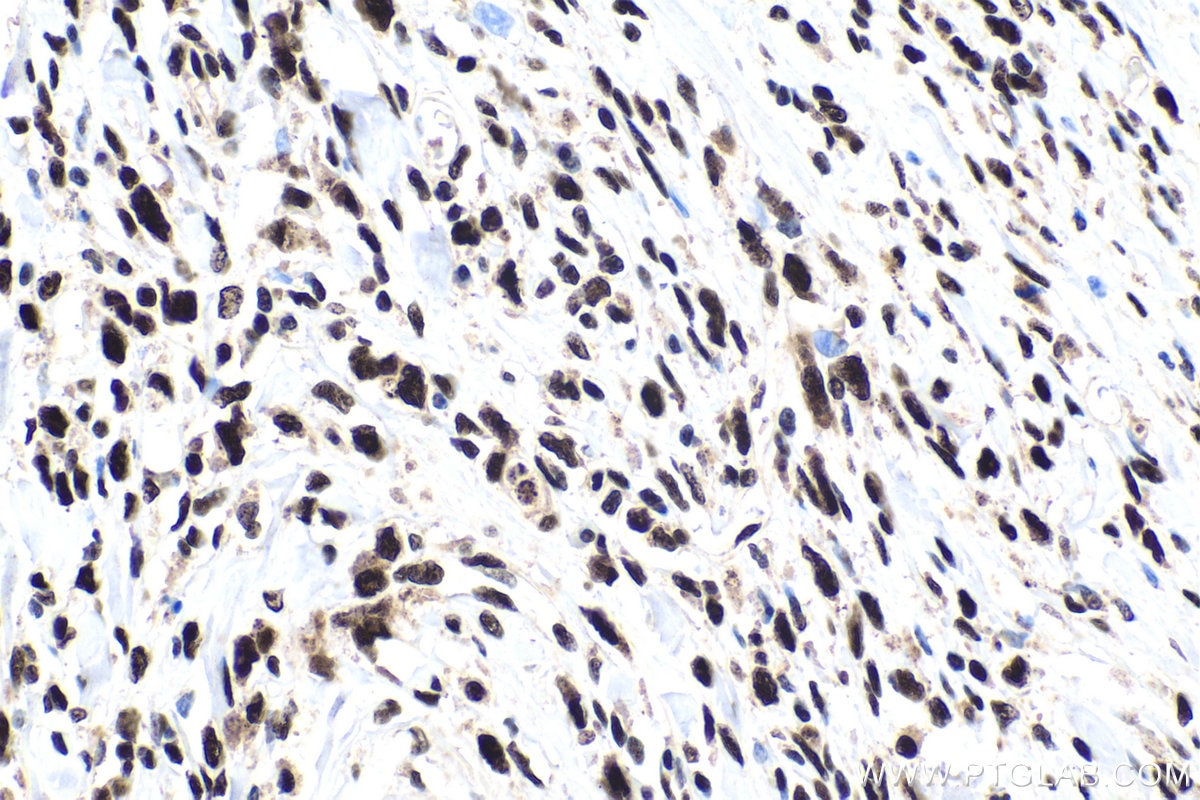 Immunohistochemical analysis of paraffin-embedded human stomach cancer tissue slide using KHC1658 (HSF1 IHC Kit).