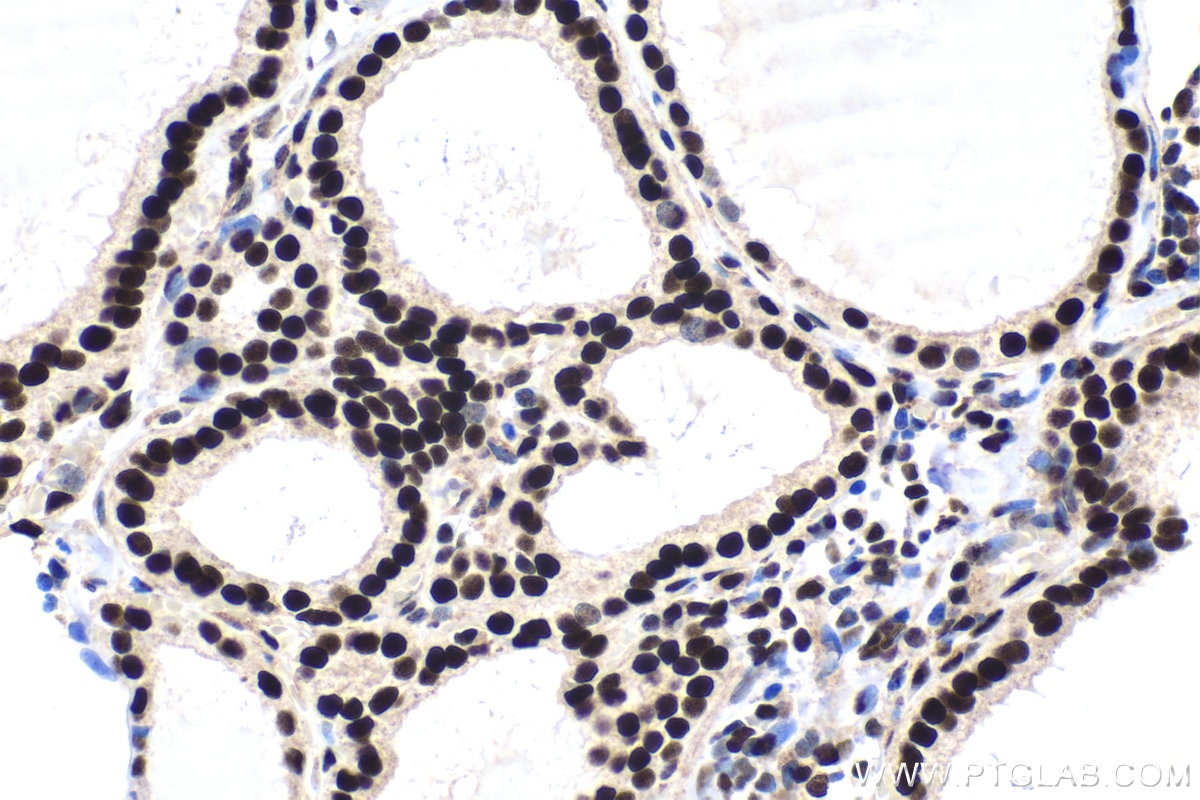 Immunohistochemical analysis of paraffin-embedded human thyroid cancer tissue slide using KHC1658 (HSF1 IHC Kit).