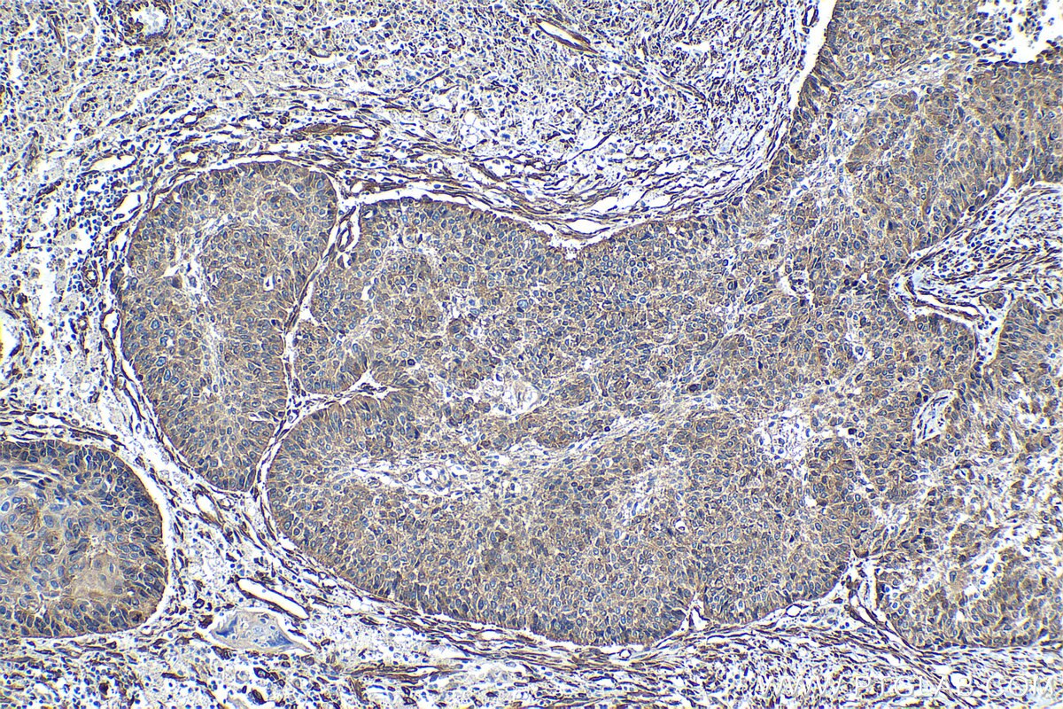 Immunohistochemical analysis of paraffin-embedded human lung cancer tissue slide using KHC1241 (HSP47 IHC Kit).