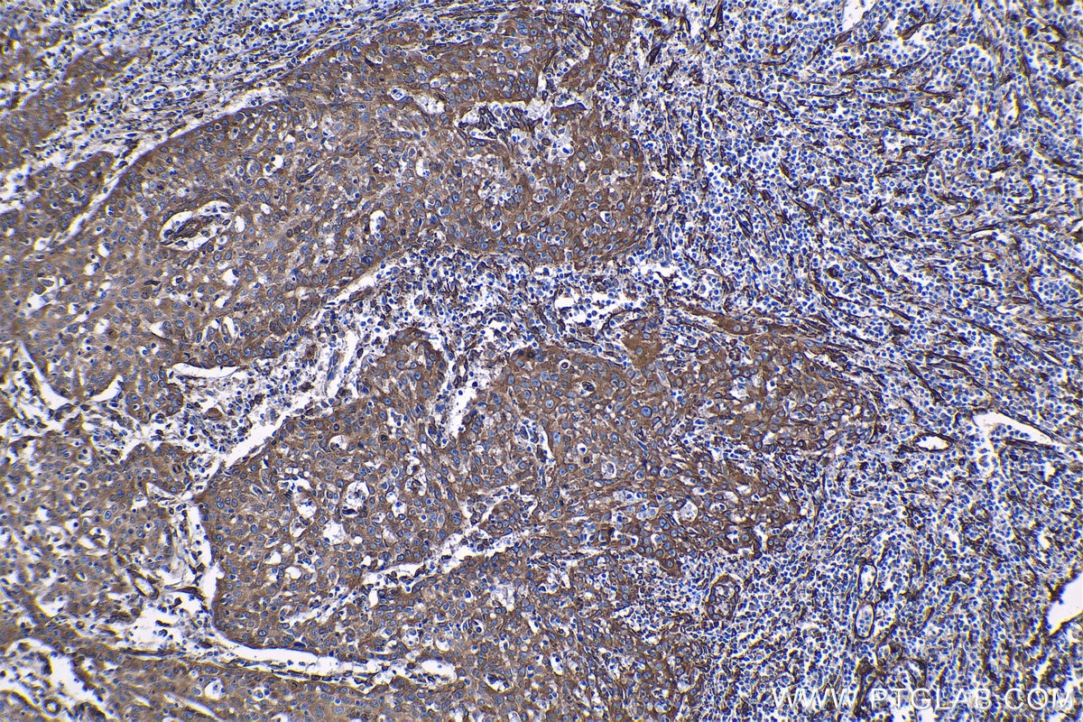 Immunohistochemical analysis of paraffin-embedded human cervical cancer tissue slide using KHC1241 (HSP47 IHC Kit).
