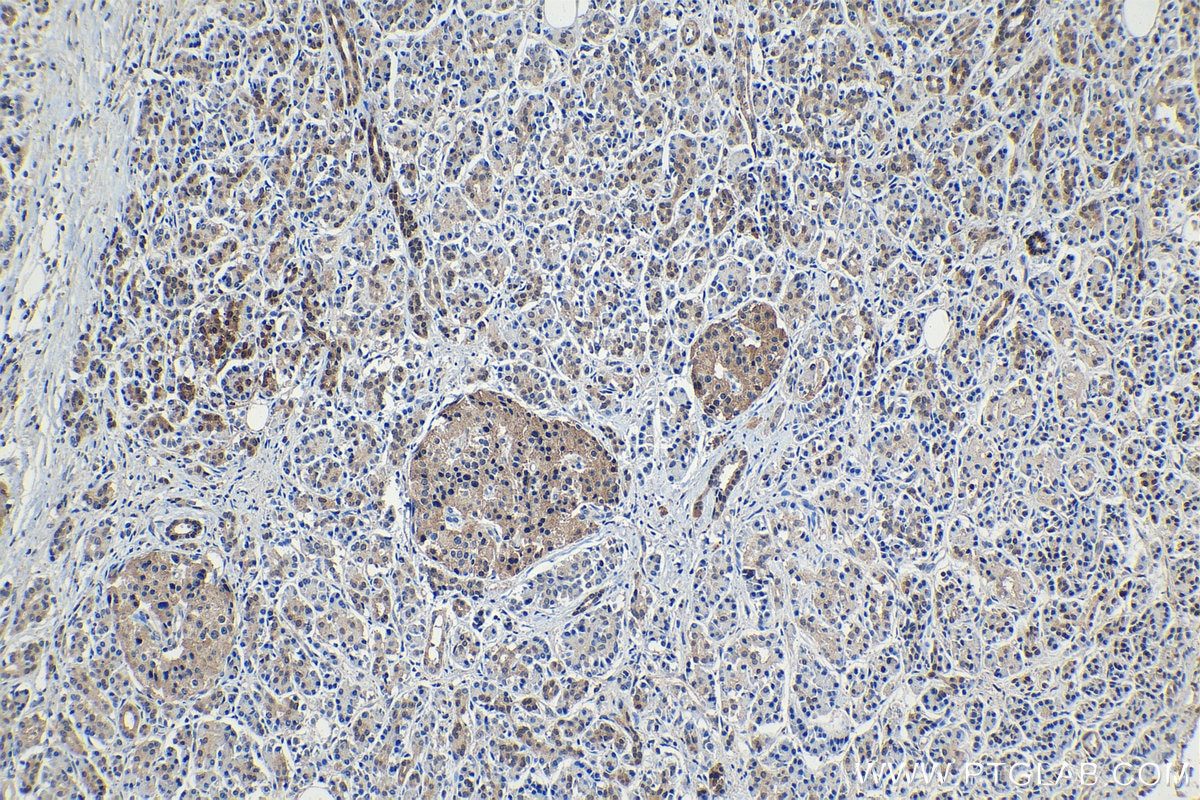 Immunohistochemical analysis of paraffin-embedded human pancreas cancer tissue slide using KHC1161 (HSP70 IHC Kit).