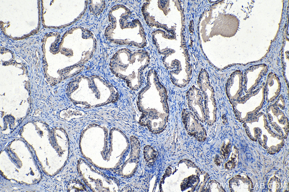 Immunohistochemical analysis of paraffin-embedded human prostate cancer tissue slide using KHC1161 (HSP70 IHC Kit).