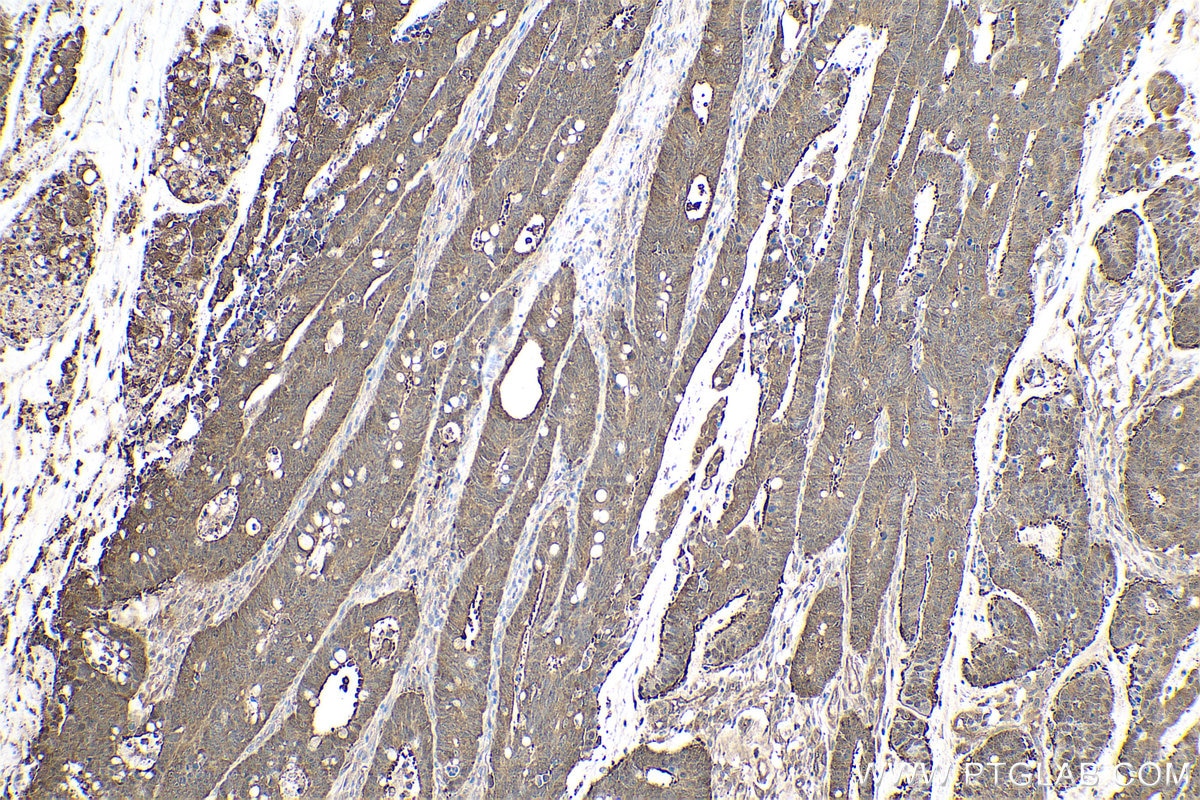 Immunohistochemical analysis of paraffin-embedded human colon cancer tissue slide using KHC0659 (HSP90AA1 IHC Kit).