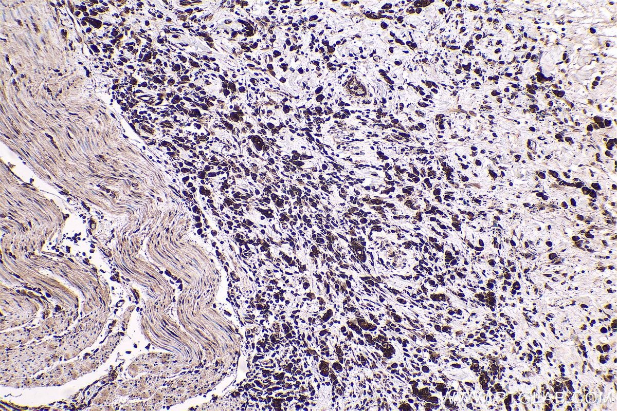 Immunohistochemical analysis of paraffin-embedded human stomach cancer tissue slide using KHC0564 (HSP90AB1 IHC Kit).