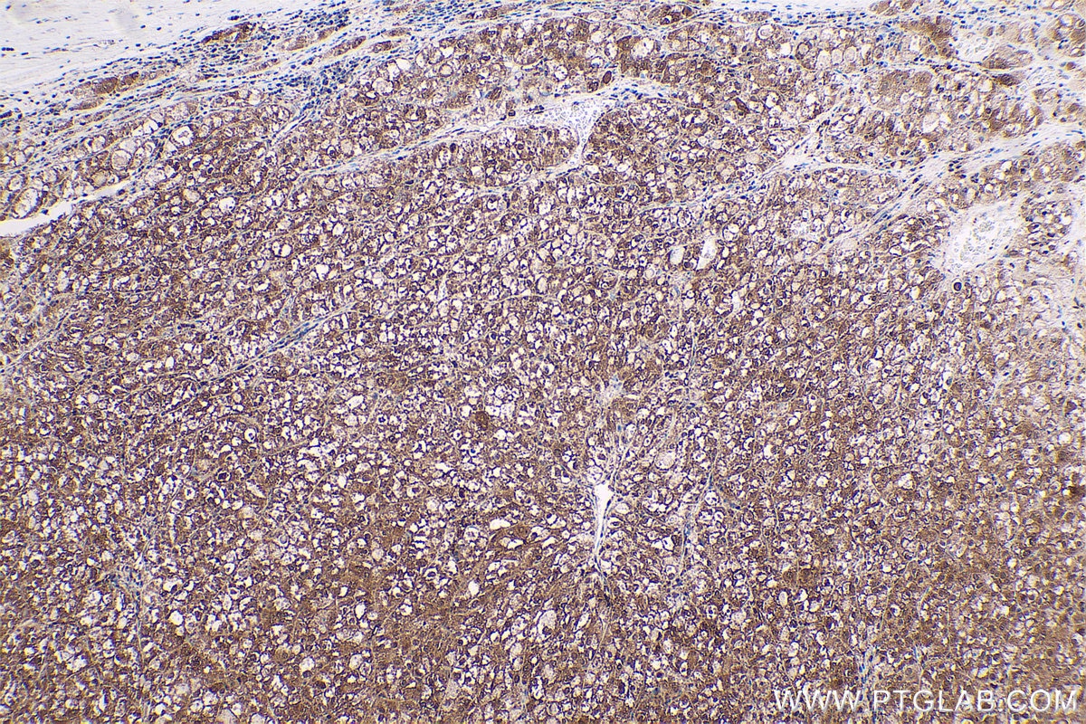 Immunohistochemical analysis of paraffin-embedded human liver cancer tissue slide using KHC0564 (HSP90AB1 IHC Kit).