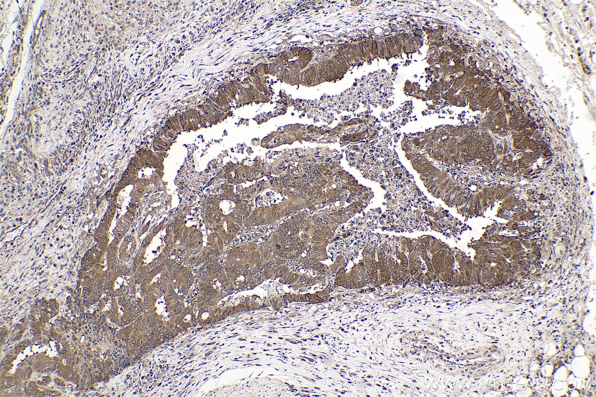 Immunohistochemical analysis of paraffin-embedded human colon cancer tissue slide using KHC0564 (HSP90AB1 IHC Kit).