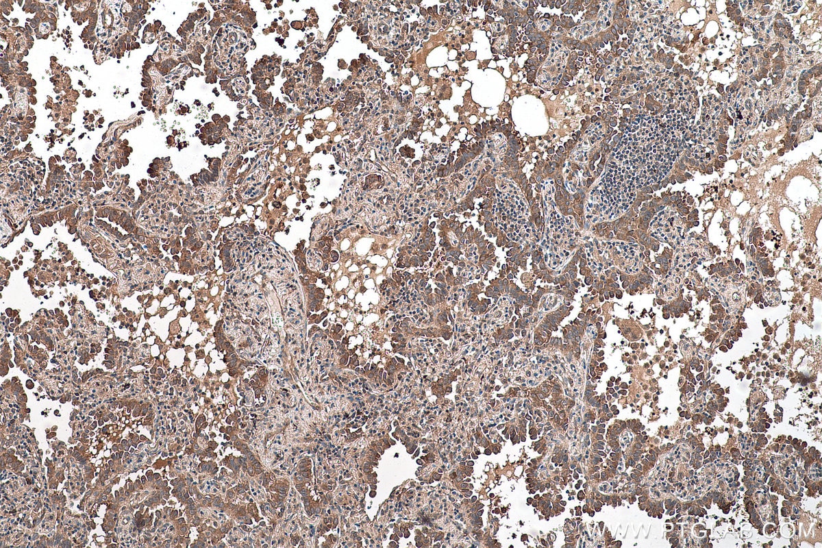 Immunohistochemical analysis of paraffin-embedded human lung cancer tissue slide using KHC0564 (HSP90AB1 IHC Kit).
