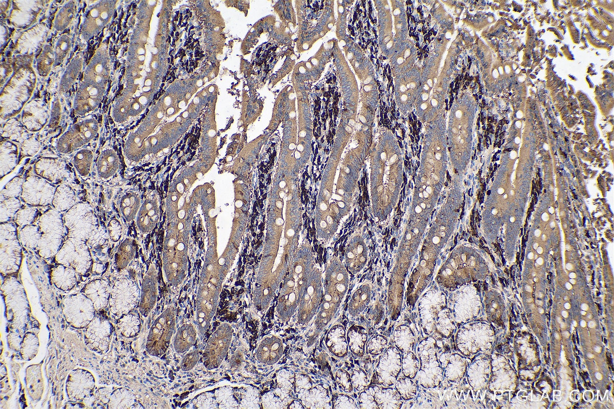 Immunohistochemical analysis of paraffin-embedded human stomach cancer tissue slide using KHC0626 (HSPA13 IHC Kit).