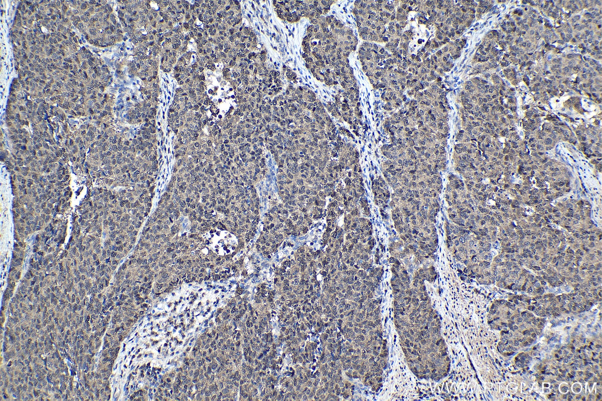 Immunohistochemical analysis of paraffin-embedded human stomach cancer tissue slide using KHC1134 (HSPA6 IHC Kit).