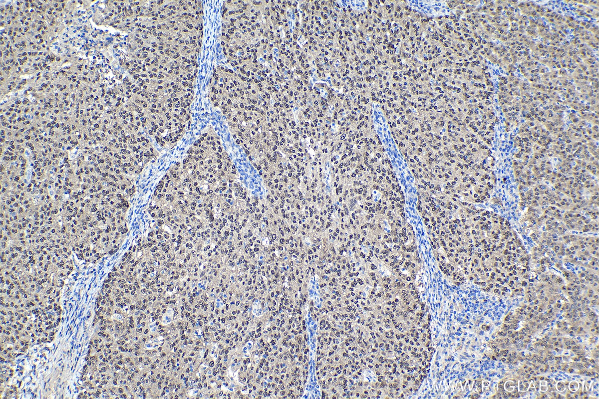 Immunohistochemical analysis of paraffin-embedded human ovary tumor tissue slide using KHC1134 (HSPA6 IHC Kit).