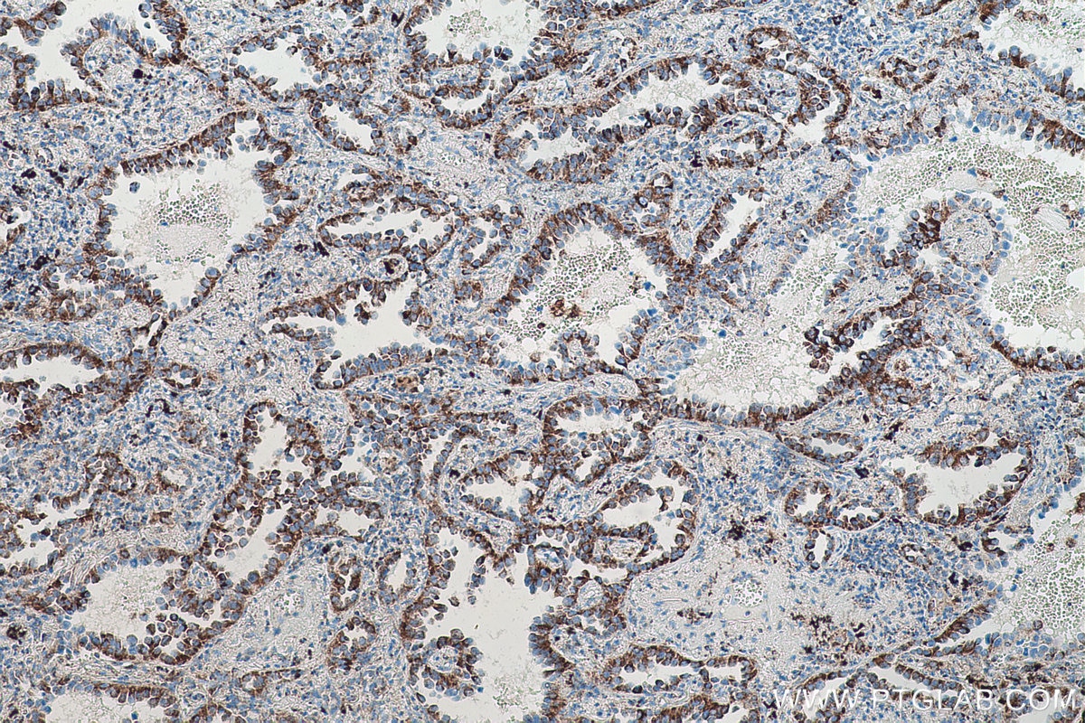 Immunohistochemical analysis of paraffin-embedded human lung cancer tissue slide using KHC0540 (HSPA9/GRP75 IHC Kit).