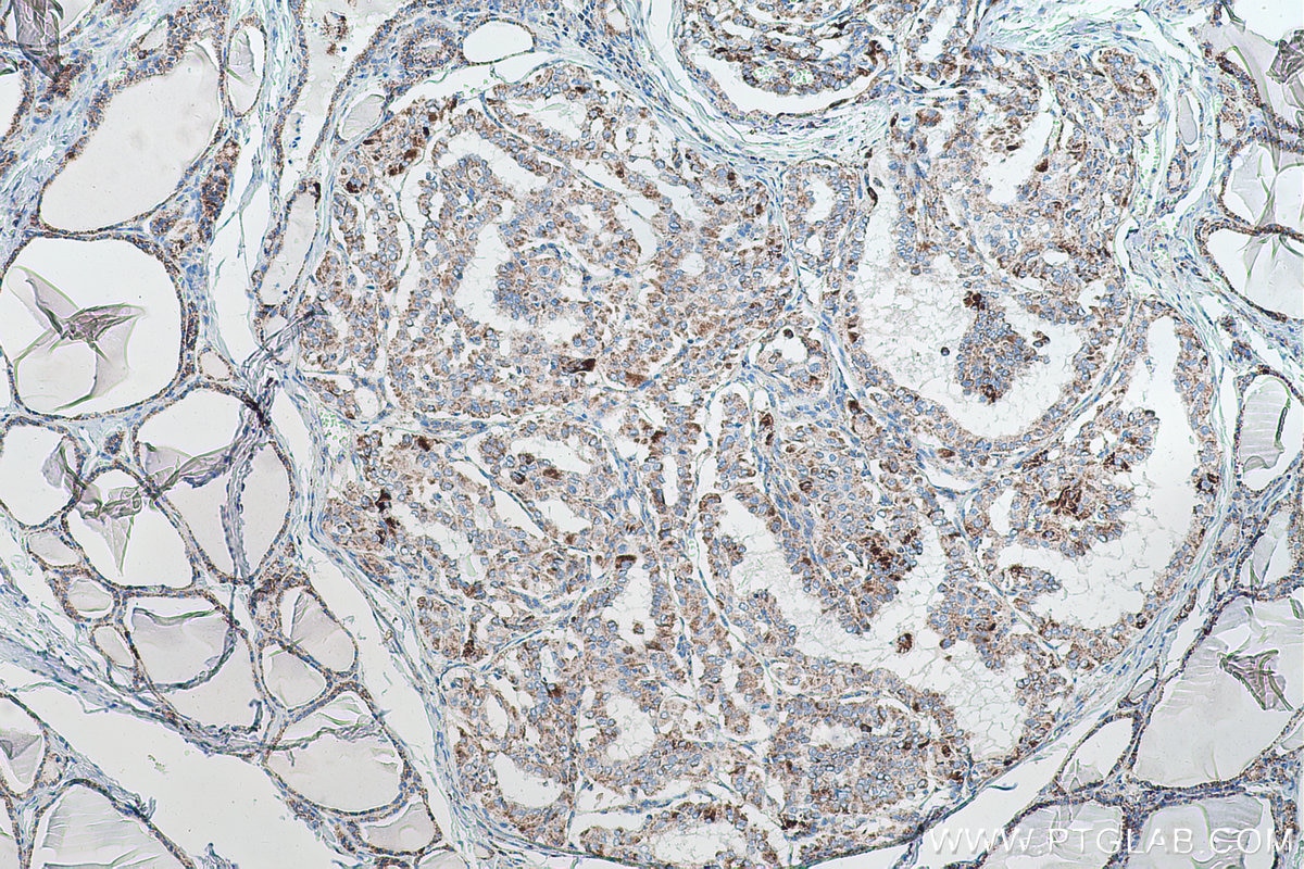 Immunohistochemical analysis of paraffin-embedded human thyroid cancer tissue slide using KHC0540 (HSPA9/GRP75 IHC Kit).