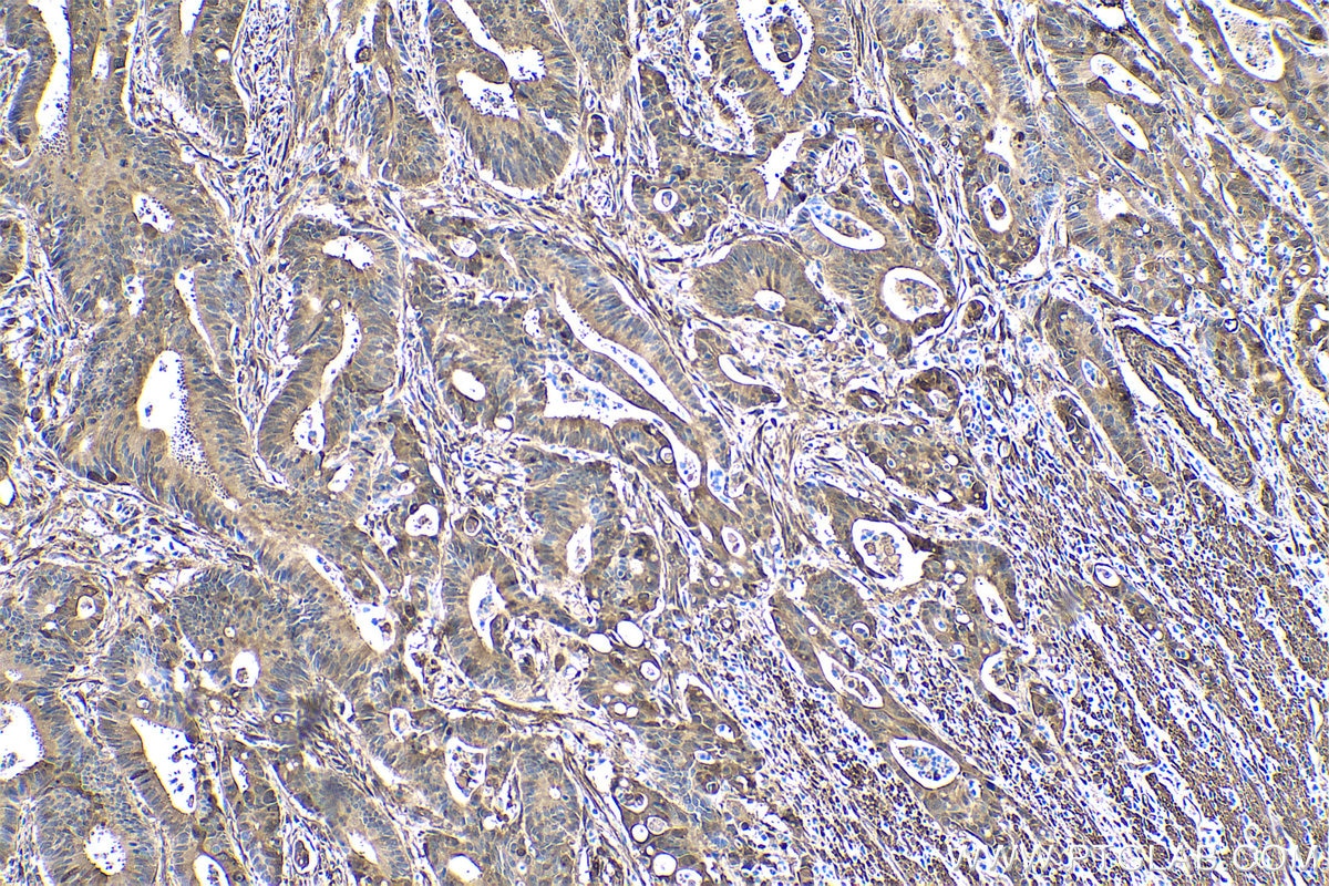 Immunohistochemical analysis of paraffin-embedded human colon cancer tissue slide using KHC0427 (HSPB1 IHC Kit).