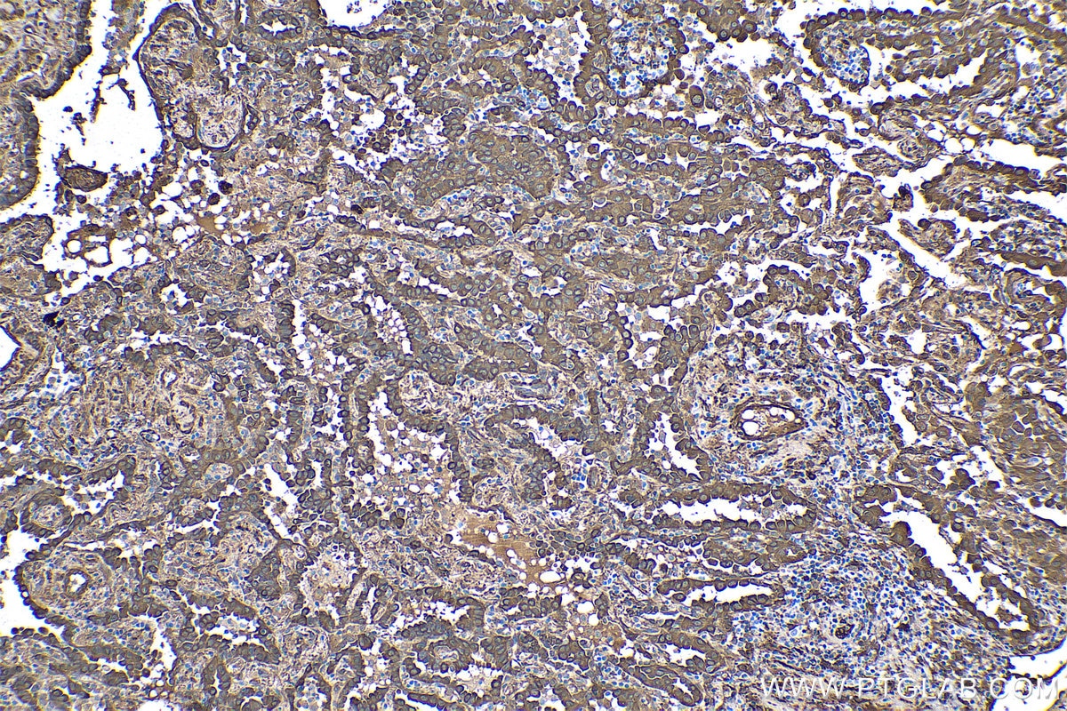 Immunohistochemical analysis of paraffin-embedded human lung cancer tissue slide using KHC0427 (HSPB1 IHC Kit).