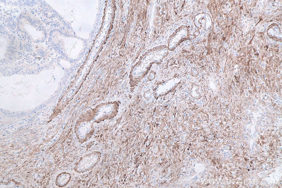 Immunohistochemical analysis of paraffin-embedded human ovary tumor tissue slide using KHC0668 (HSPB6 IHC Kit).