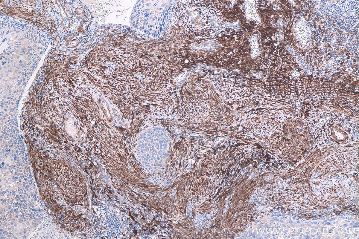 Immunohistochemical analysis of paraffin-embedded human cervical cancer tissue slide using KHC0668 (HSPB6 IHC Kit).