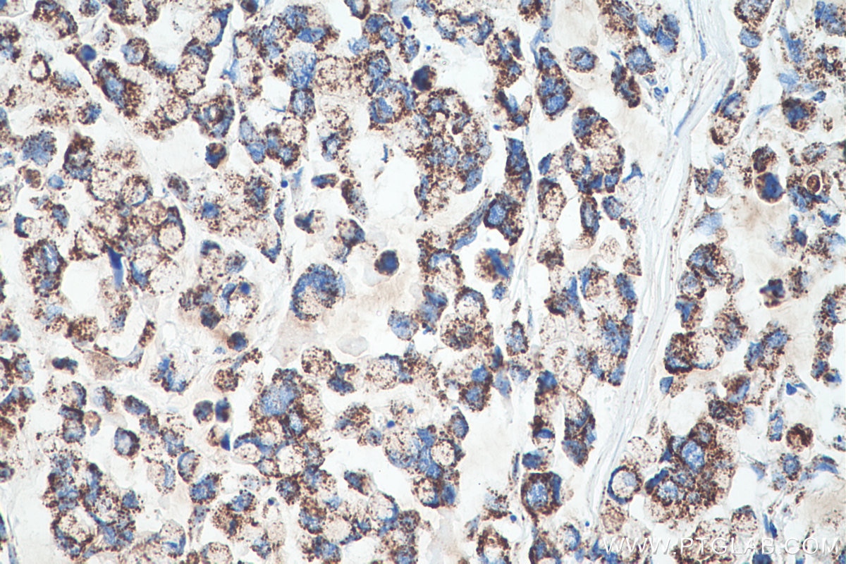 Immunohistochemical analysis of paraffin-embedded human colon cancer tissue slide using KHC0505 (HSPD1 IHC Kit).