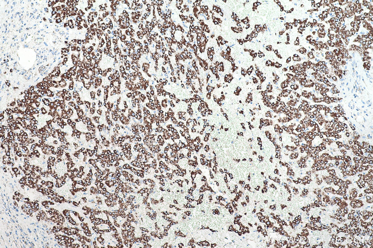 Immunohistochemical analysis of paraffin-embedded human liver cancer tissue slide using KHC0505 (HSPD1 IHC Kit).