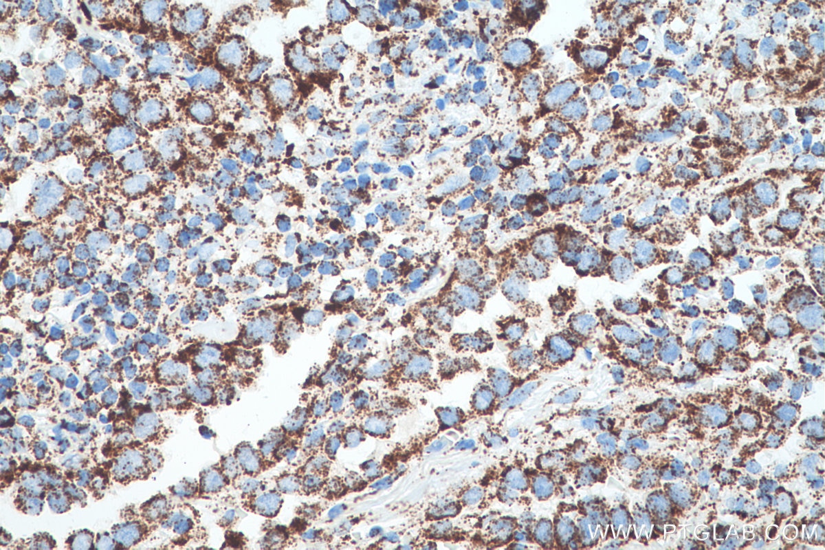 Immunohistochemical analysis of paraffin-embedded human lung cancer tissue slide using KHC0505 (HSPD1 IHC Kit).