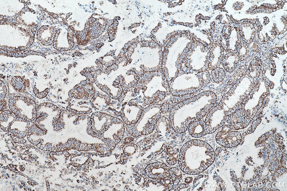 Immunohistochemical analysis of paraffin-embedded human ovary tumor tissue slide using KHC0505 (HSPD1 IHC Kit).