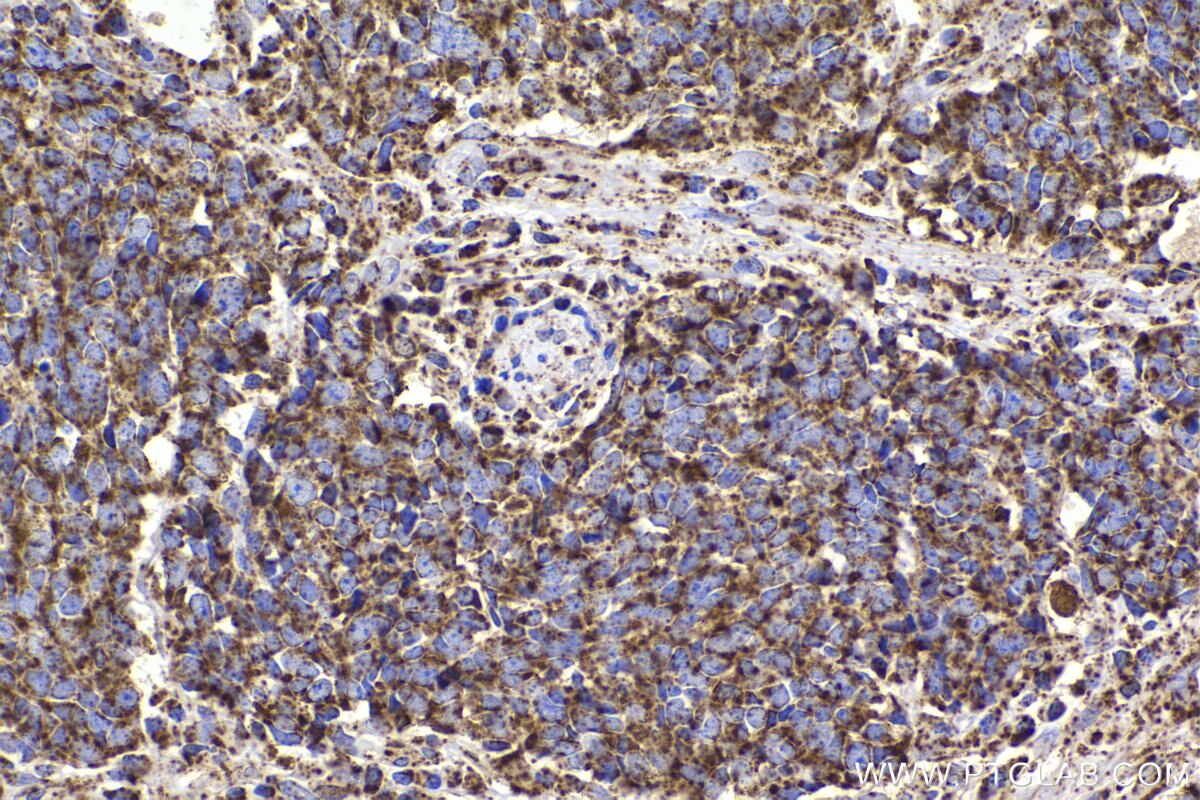 Immunohistochemical analysis of paraffin-embedded human lung cancer tissue slide using KHC2340 (HSP10 IHC Kit).