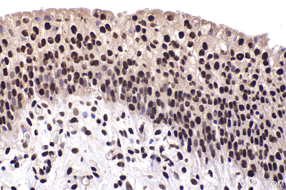 Immunohistochemical analysis of paraffin-embedded human urothelial carcinoma tissue slide using KHC1456 (HTATSF1 IHC Kit).