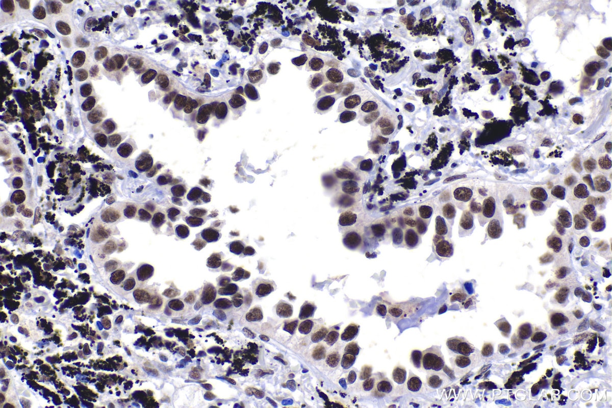 Immunohistochemical analysis of paraffin-embedded human lung cancer tissue slide using KHC1456 (HTATSF1 IHC Kit).