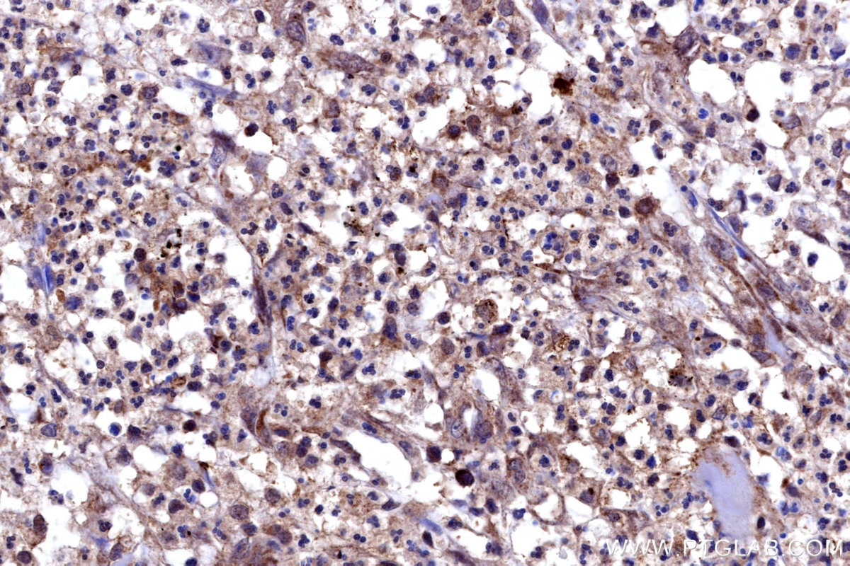 Immunohistochemical analysis of paraffin-embedded human colon cancer tissue slide using KHC3185 (HTN3 IHC Kit).
