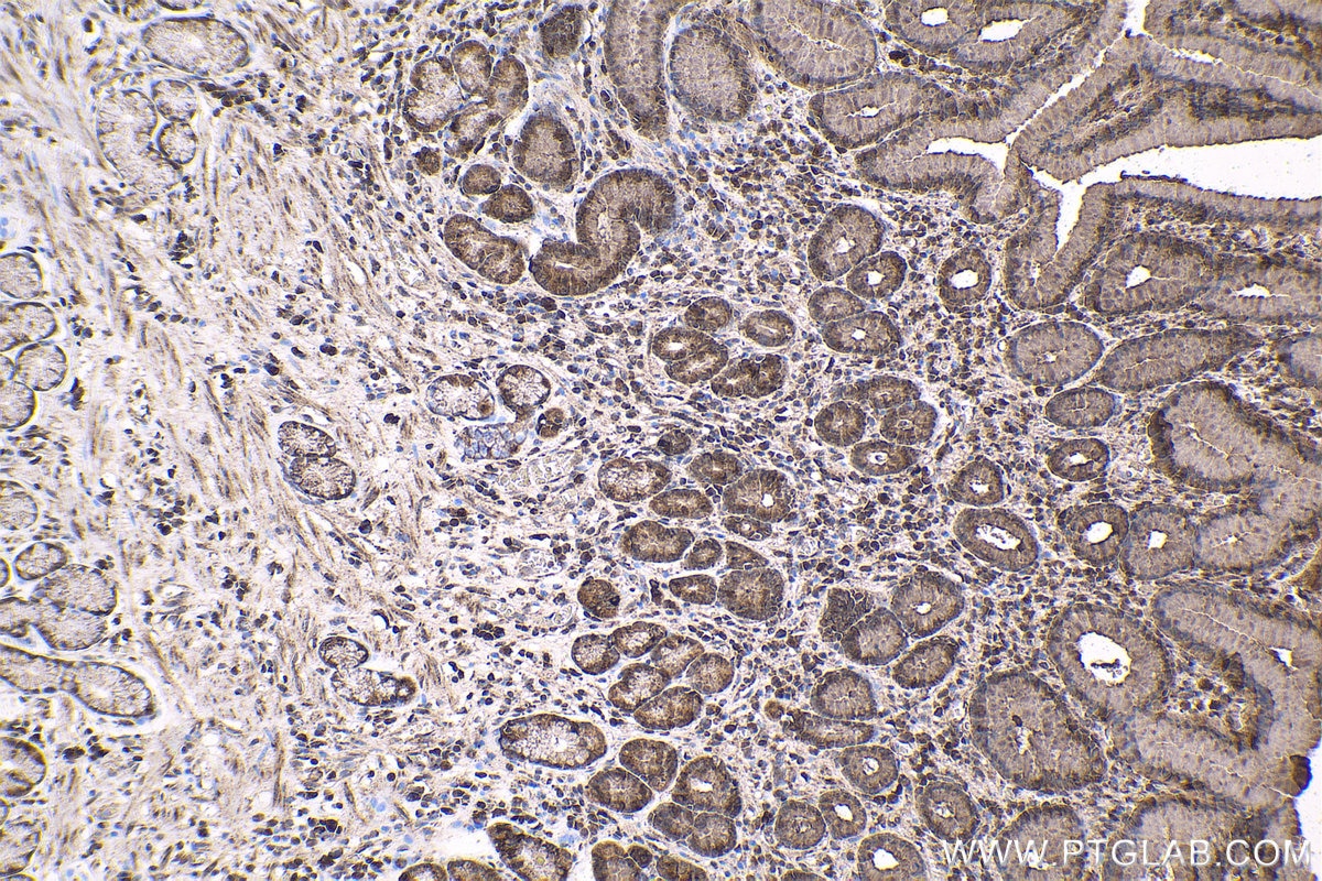 Immunohistochemical analysis of paraffin-embedded human stomach cancer tissue slide using KHC1597 (HTT IHC Kit).