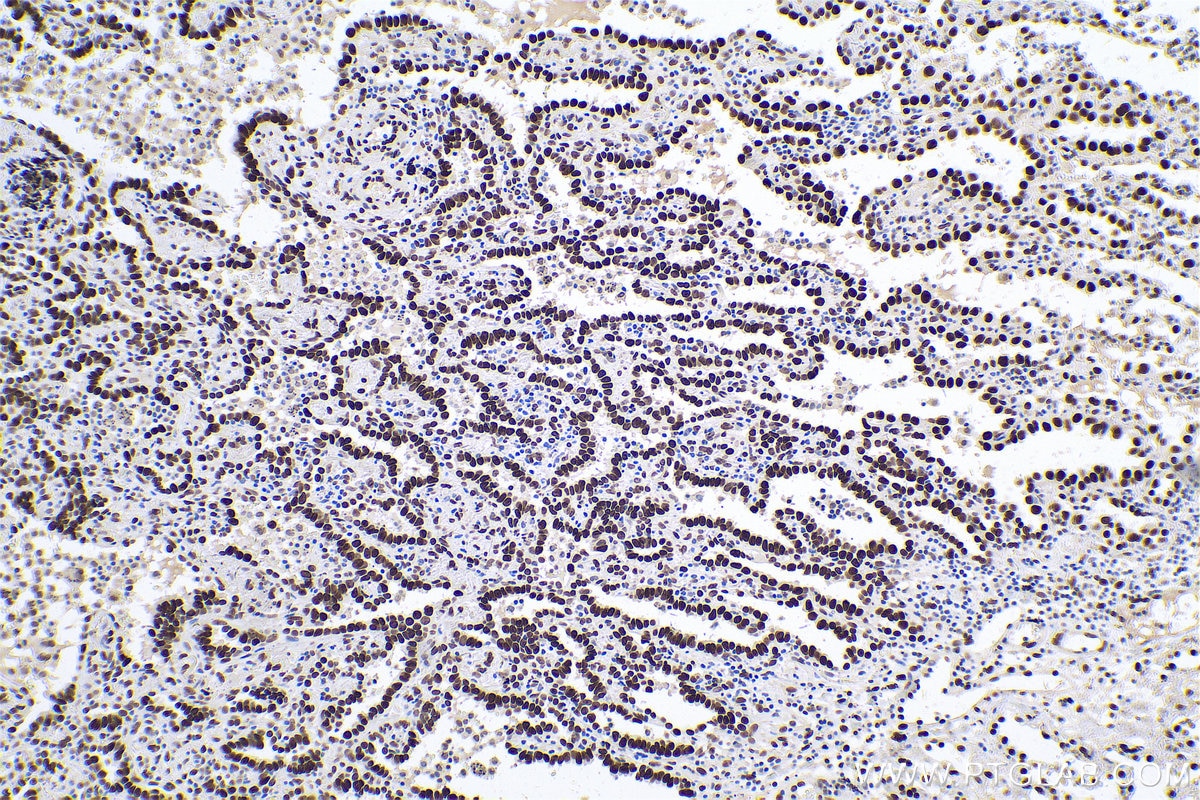 Immunohistochemical analysis of paraffin-embedded human lung cancer tissue slide using KHC0594 (Histone H1.0 IHC Kit).