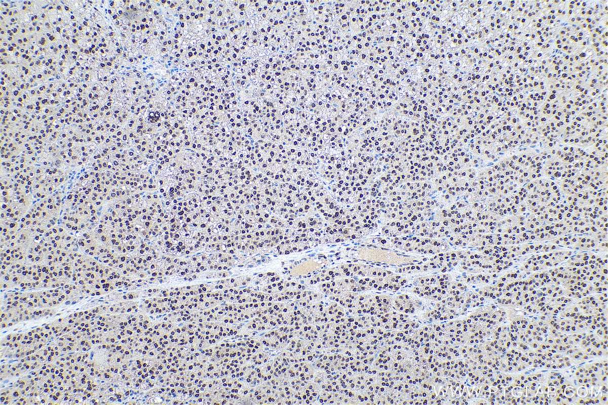 Immunohistochemical analysis of paraffin-embedded human liver cancer tissue slide using KHC0594 (Histone H1.0 IHC Kit).