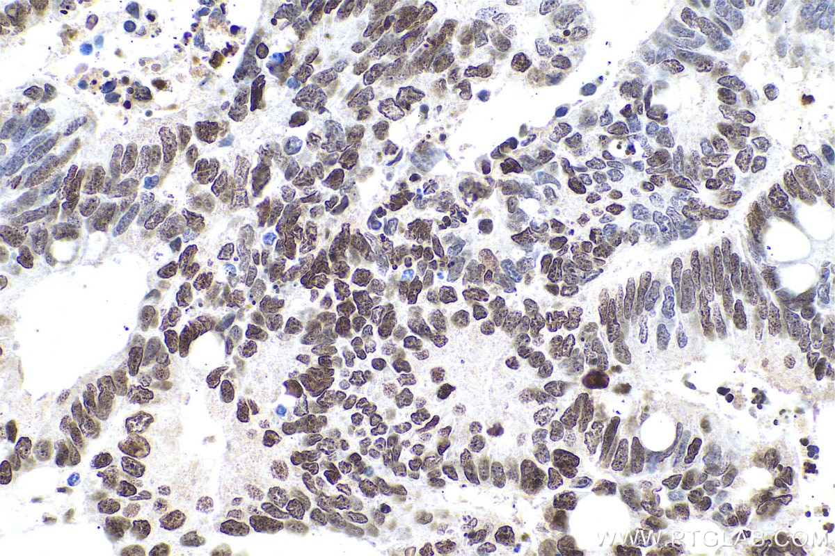 Immunohistochemical analysis of paraffin-embedded human colon cancer tissue slide using KHC0594 (Histone H1.0 IHC Kit).