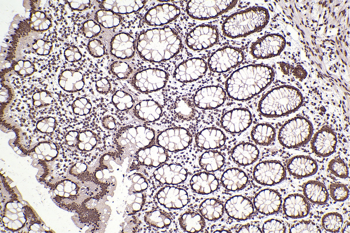 Immunohistochemical analysis of paraffin-embedded human rectal cancer tissue slide using KHC2506 (Histone H3.4 IHC Kit).