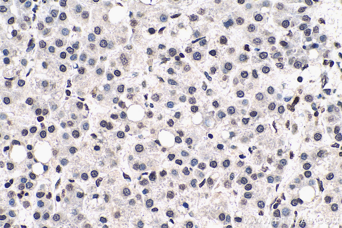Immunohistochemical analysis of paraffin-embedded human liver cancer tissue slide using KHC0568 (Histone-H3 IHC Kit).