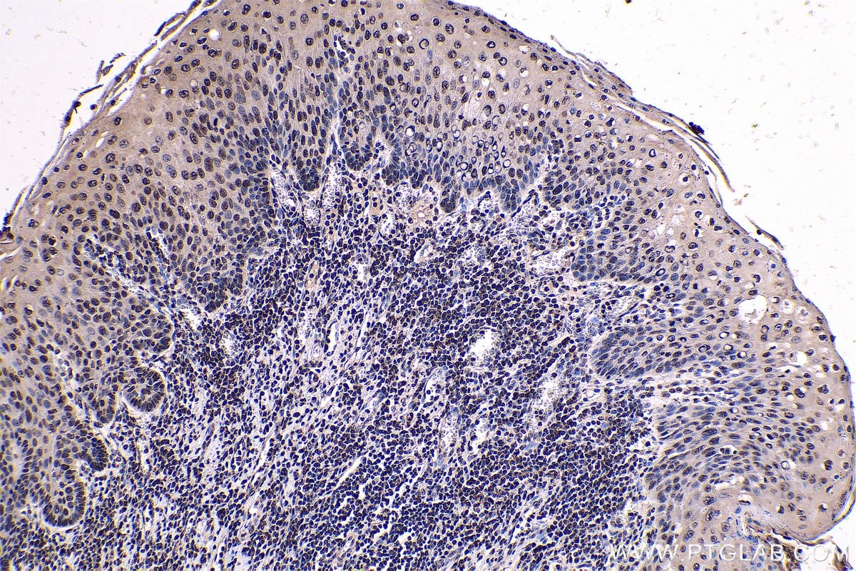 Immunohistochemical analysis of paraffin-embedded human oesophagus cancer tissue slide using KHC0568 (Histone-H3 IHC Kit).