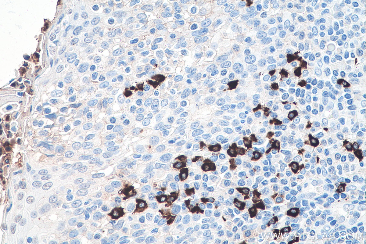 Immunohistochemical analysis of paraffin-embedded human tonsillitis tissue slide using KHC0074 (Human IgG4 IHC Kit).