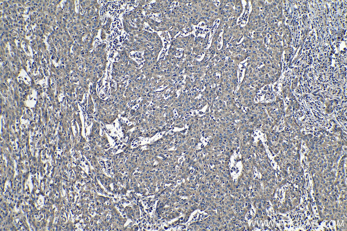 Immunohistochemical analysis of paraffin-embedded human cervical cancer tissue slide using KHC1238 (IARS2 IHC Kit).