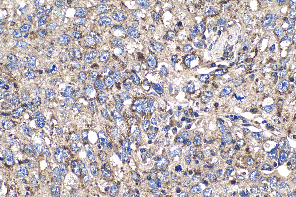 Immunohistochemical analysis of paraffin-embedded human lung cancer tissue slide using KHC1238 (IARS2 IHC Kit).