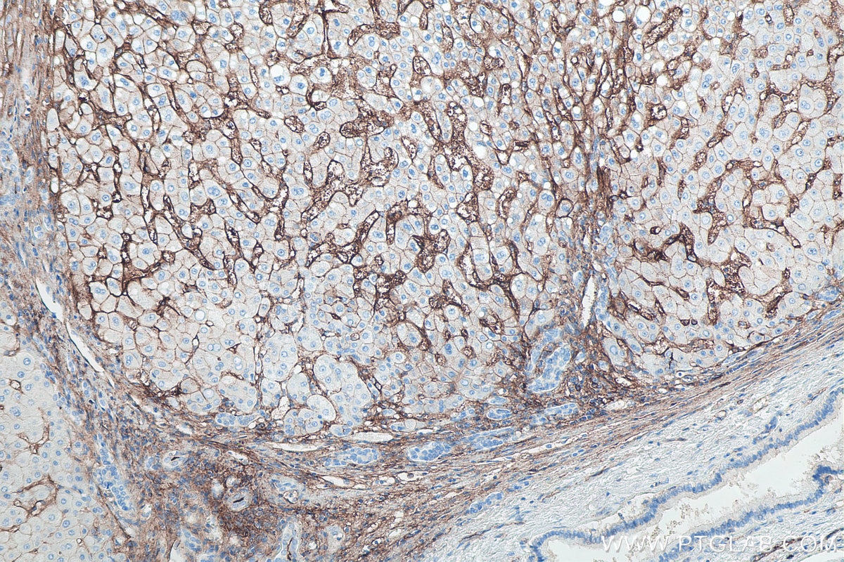 Immunohistochemical analysis of paraffin-embedded human liver cancer tissue slide using KHC0080 (ICAM-1 IHC Kit).