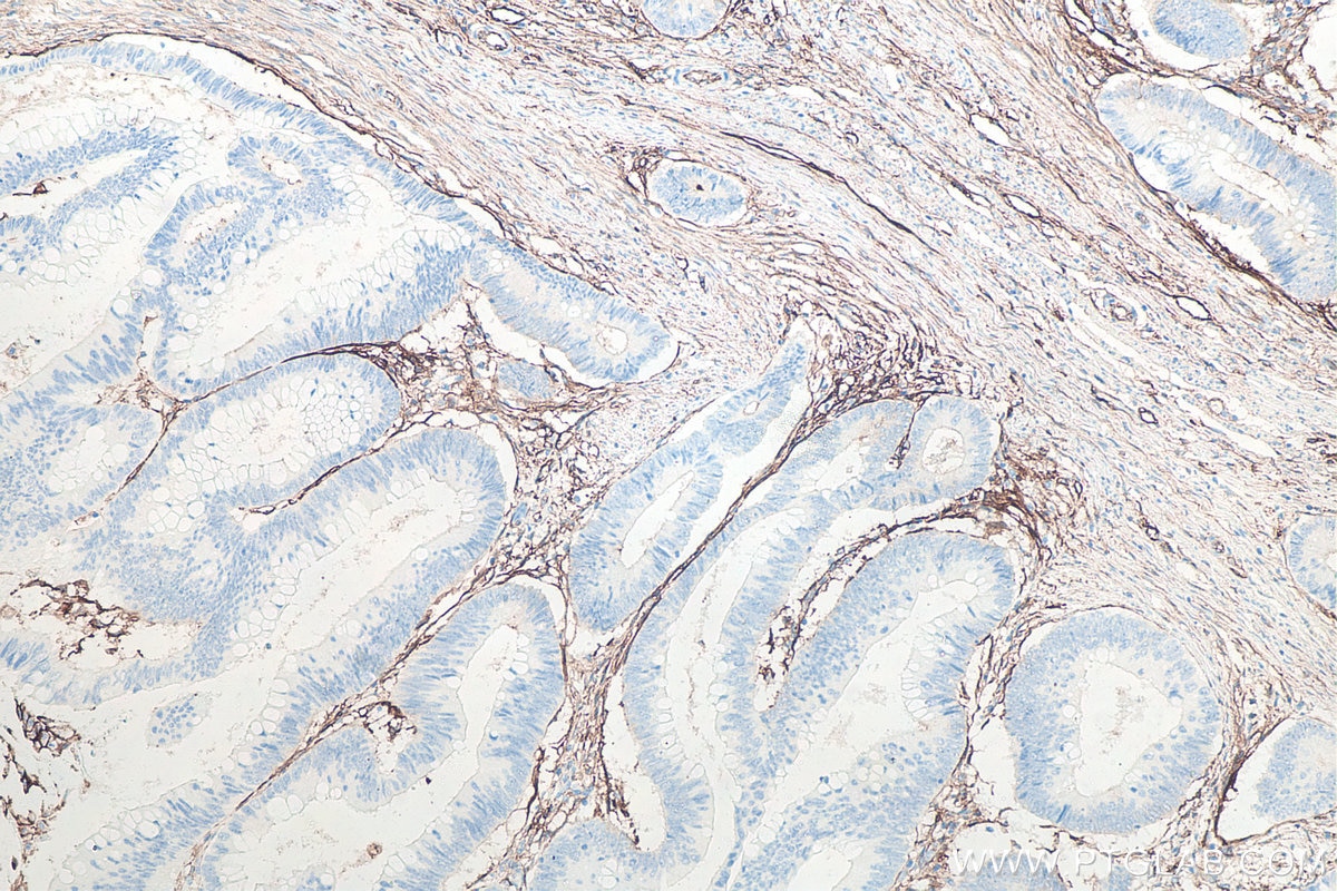 Immunohistochemical analysis of paraffin-embedded human colon cancer tissue slide using KHC0080 (ICAM-1 IHC Kit).