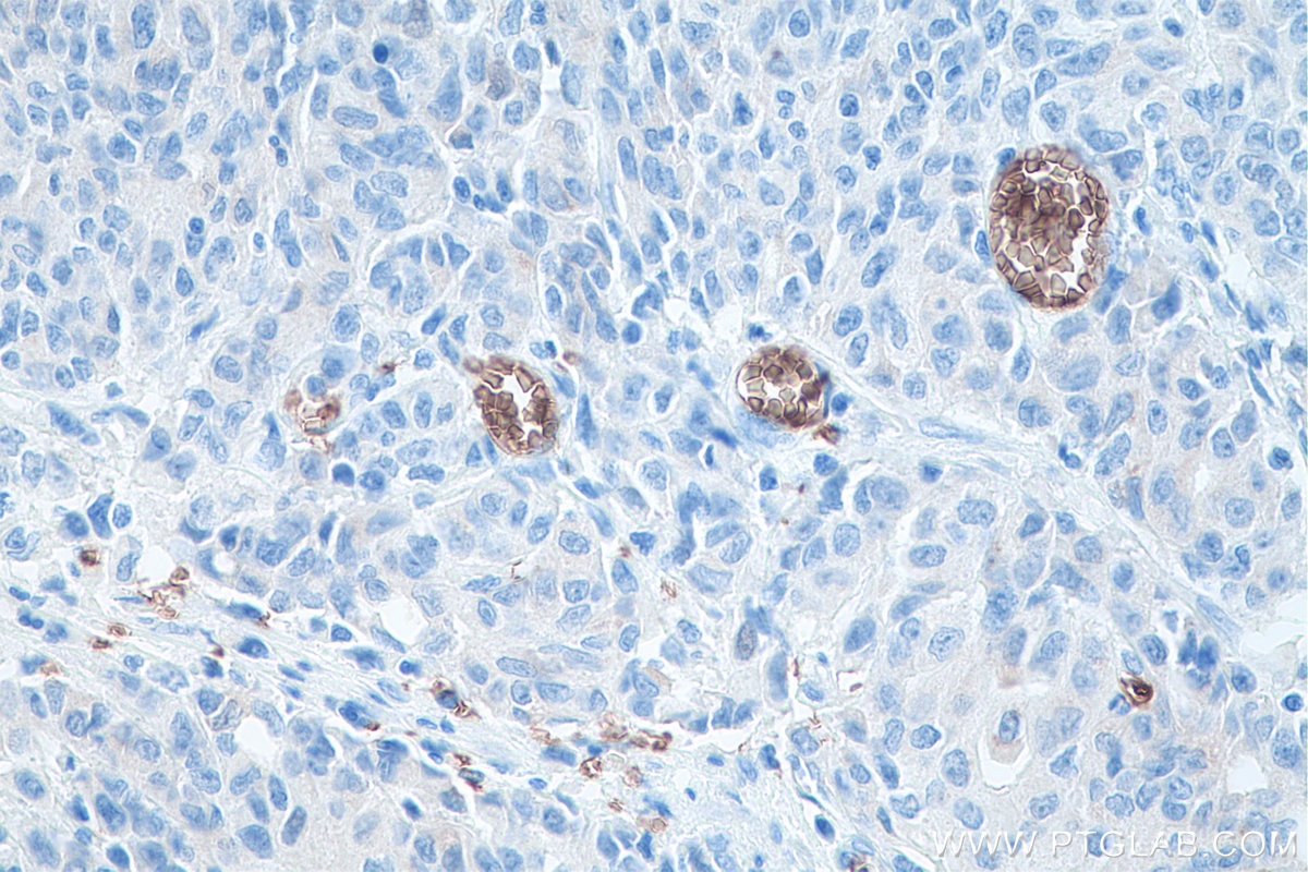 Immunohistochemical analysis of paraffin-embedded human stomach cancer tissue slide using KHC0077 (ICAM4 IHC Kit).