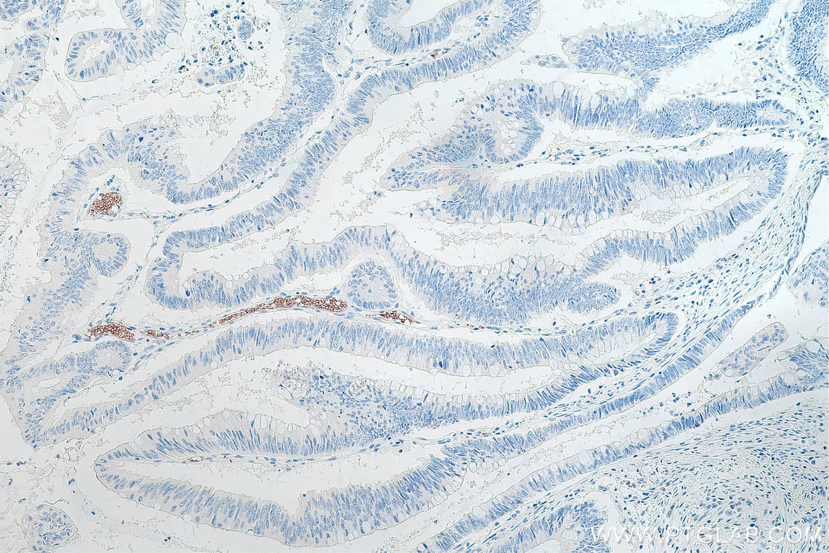 Immunohistochemical analysis of paraffin-embedded human colon cancer tissue slide using KHC0077 (ICAM4 IHC Kit).