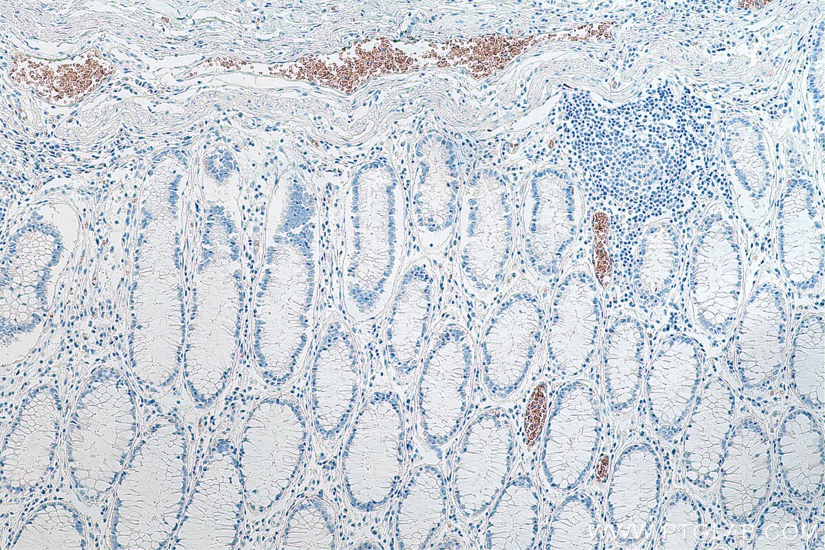 Immunohistochemical analysis of paraffin-embedded human colon cancer tissue slide using KHC0077 (ICAM4 IHC Kit).