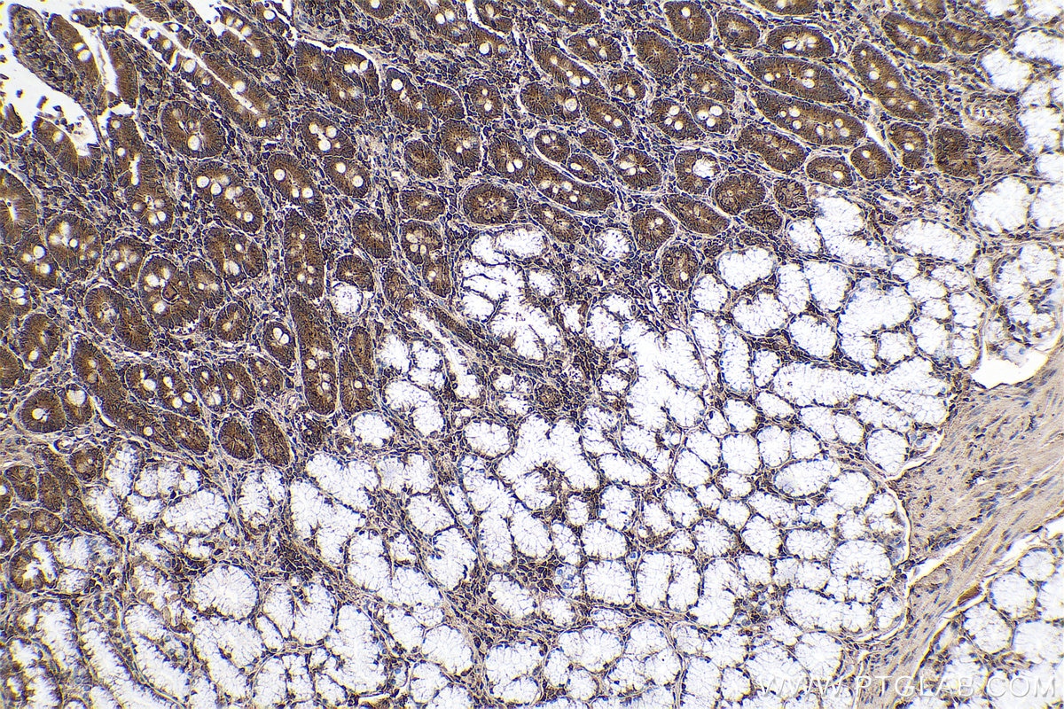 Immunohistochemical analysis of paraffin-embedded human stomach cancer tissue slide using KHC0627 (ID1 IHC Kit).