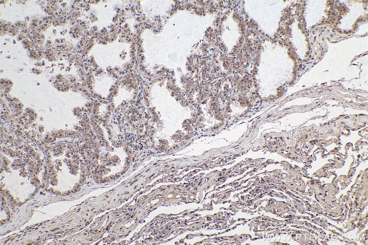Immunohistochemical analysis of paraffin-embedded human lung cancer tissue slide using KHC0627 (ID1 IHC Kit).