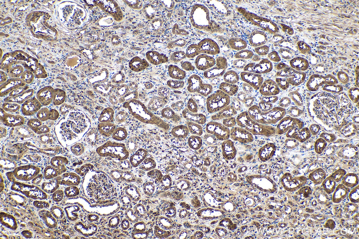 Immunohistochemical analysis of paraffin-embedded human renal cell carcinoma(NAT) tissue slide using KHC0541 (IDH1 IHC Kit).